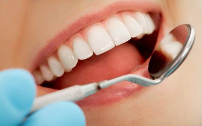 Dental Crowns: Can You Whiten Them?